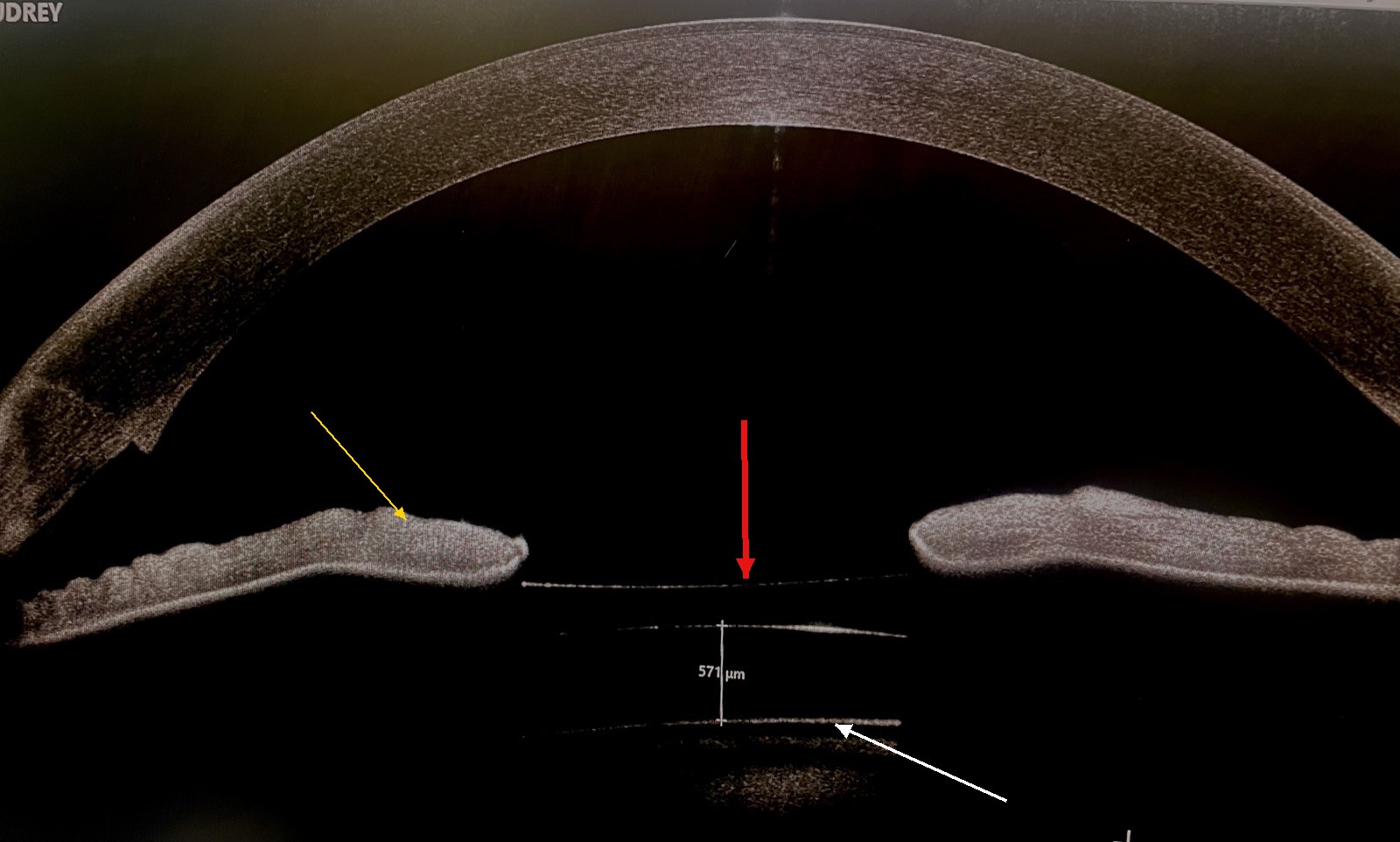 Coupe OCT annotée montrant l'implant ICL sous l'iris et devant le cristallin, avec flèches indiquant l'implant, l'iris et le cristallin