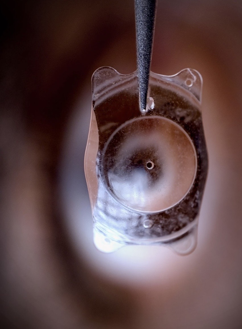 Gros plan sur un implant ICL positionné devant la pupille