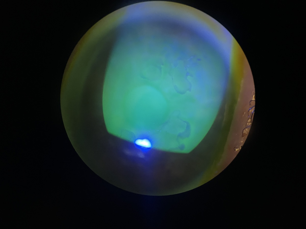 Coloration à la fluorescéine sous éclairage bleu cobalt d'une kératalgie récidivante