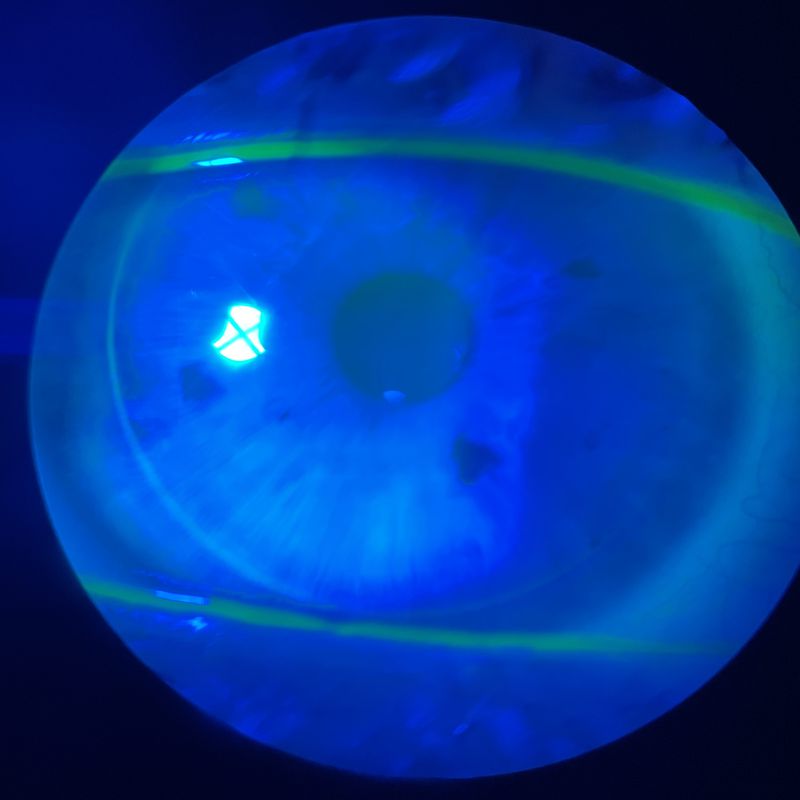 Même œil après traitement de la surface oculaire : la cornée ne fixe plus la fluorescéine, l'iris et la pupille apparaissent nettement