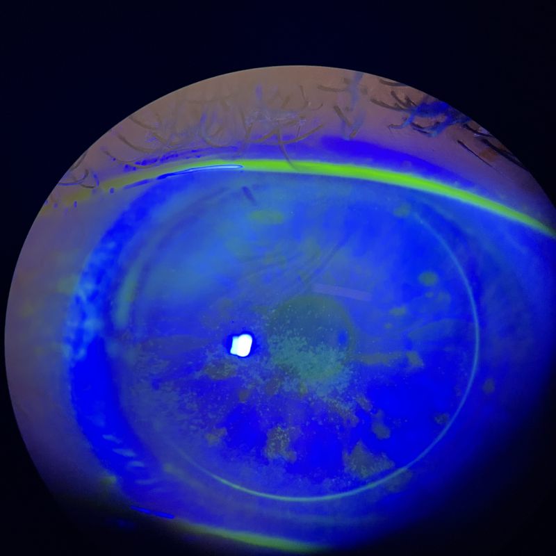 Coloration à la fluorescéine sous lumière bleue montrant une kératite ponctuée superficielle marquée : nombreuses taches vertes disséminées sur la cornée